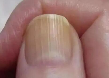 指甲有竖纹是身体的什么信号（指甲有竖纹怎么调理）