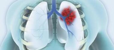 肺癌晚期能活多久？晚期肺癌还能活多久？